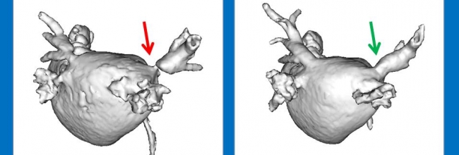 tdp stents