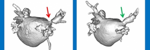 tdp stents
