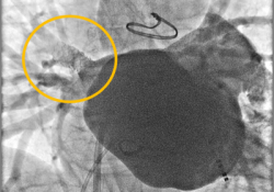 tdp stents